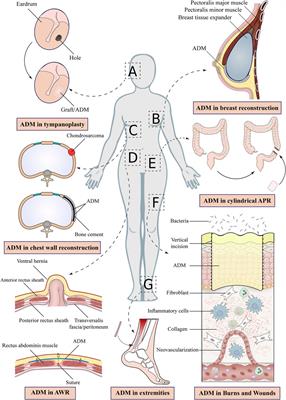 Acellular dermal matrix in reconstructive surgery: Applications, benefits, and cost